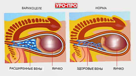 Варикоцеле и репродуктивная функция | beton-krasnodaru.ru — Урологический информационный портал!